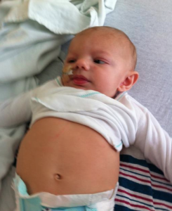 First day of NG feedings…he took that tube out twice that night! Also last picture of his tummy without a stoma.